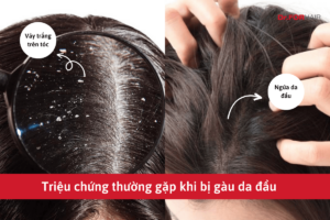 Bị gàu lâu có thể dẫn đến gàu da đầu 